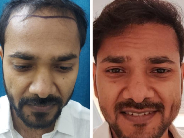 Specialists of Beard Transplants