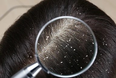 Dandruff Treatment