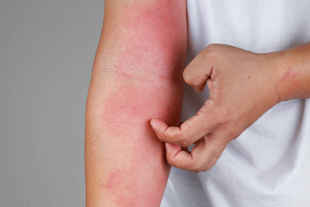 Dermatitis Treatment