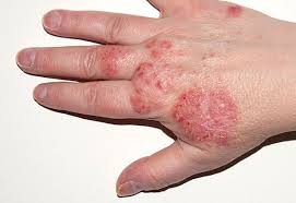 Eczema Treatment