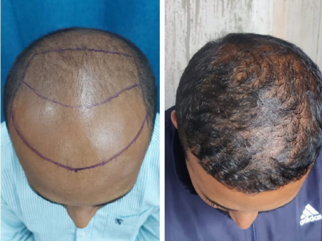 World leaders in sapphire FUE